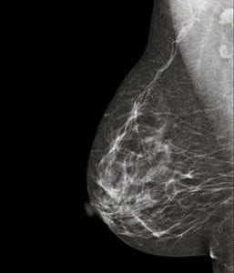 mamografia-sevilla-resolana